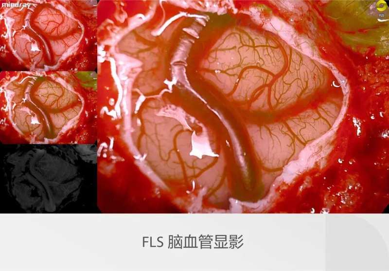  迈瑞全域荧光智能影像平台，探索精准外科未达之“镜” 新闻 迈瑞全域荧光智能影像平台，探索精准外科未达之“镜” 新闻